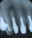歯根嚢胞　症例レントゲン1