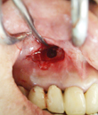 歯根嚢胞 症例3